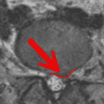 Spinal MRI highlighting left L5–S1 herniated disc not identified in the original radiology report.