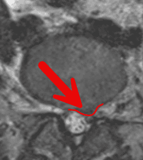 Spinal MRI highlighting left L5–S1 herniated disc not identified in the original radiology report.