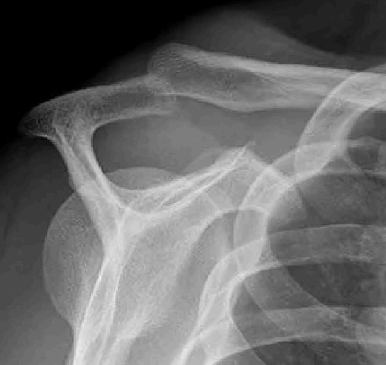 Transcapular Y-view X-ray showing shoulder anatomy used for diagnostic assessment of shoulder injuries