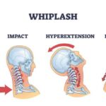 Biomechanical diagram illustrating signs of whiplash after a car accident affecting the cervical spine