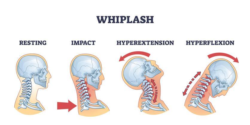 Biomechanical diagram illustrating signs of whiplash after a car accident affecting the cervical spine